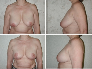 Breast Reduction | Plastic Surgery of Tulsa