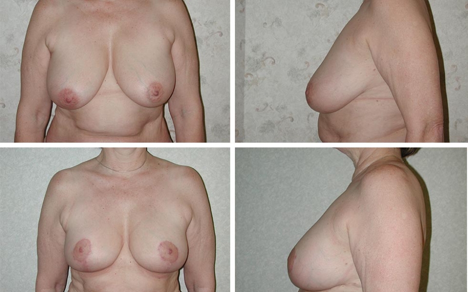 Breast Reduction | Plastic Surgery of Tulsa