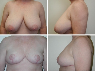 Breast Reduction | Plastic Surgery of Tulsa