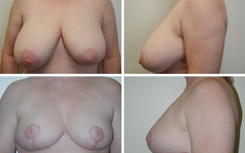 Breast Reduction | Plastic Surgery of Tulsa