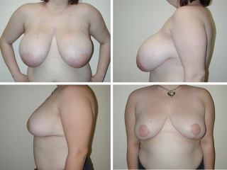 Breast Reduction | Plastic Surgery of Tulsa