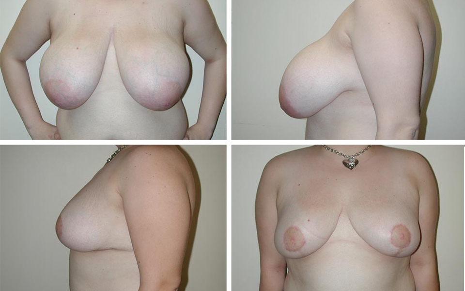 Breast Reduction | Plastic Surgery of Tulsa