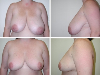 Breast Reduction | Plastic Surgery of Tulsa