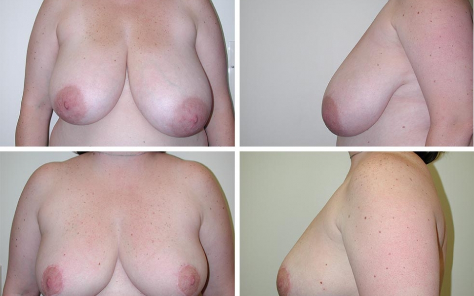 Breast Reduction | Plastic Surgery of Tulsa