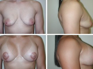 Breast Reconstruction | Plastic Surgery of Tulsa