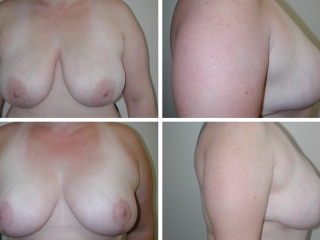 Breast Reduction | Plastic Surgery of Tulsa