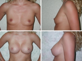 Breast Augmentation | Plastic Surgery of Tulsa