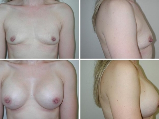 Breast Augmentation | Plastic Surgery of Tulsa