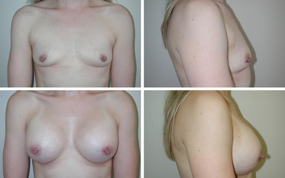 Breast Augmentation | Plastic Surgery of Tulsa