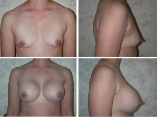 tulsa breast augmentation