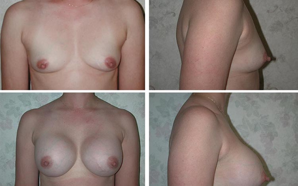 tulsa breast augmentation