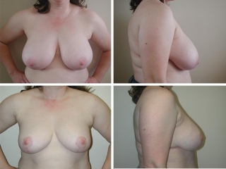 Breast Reduction | Plastic Surgery of Tulsa