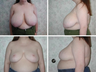 Breast Reduction | Plastic Surgery of Tulsa