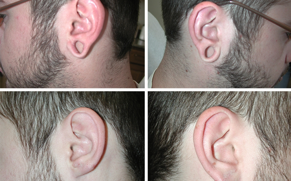 Gauges | Plastic Surgery of Tulsa