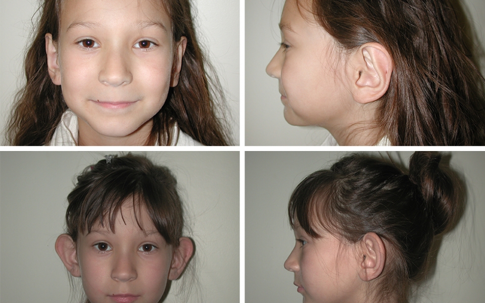 Otoplasty | Ear Pinning | Plastic Surgery of Tulsa