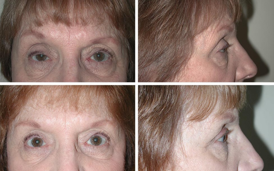 Blepharoplasty | Plastic Surgery of Tulsa