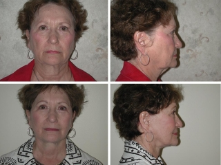 Facelift | Plastic Surgery of Tulsa