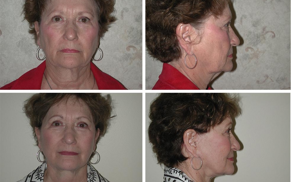 Facelift | Plastic Surgery of Tulsa