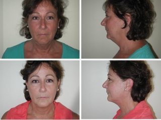 Facelift | Plastic Surgery of Tulsa