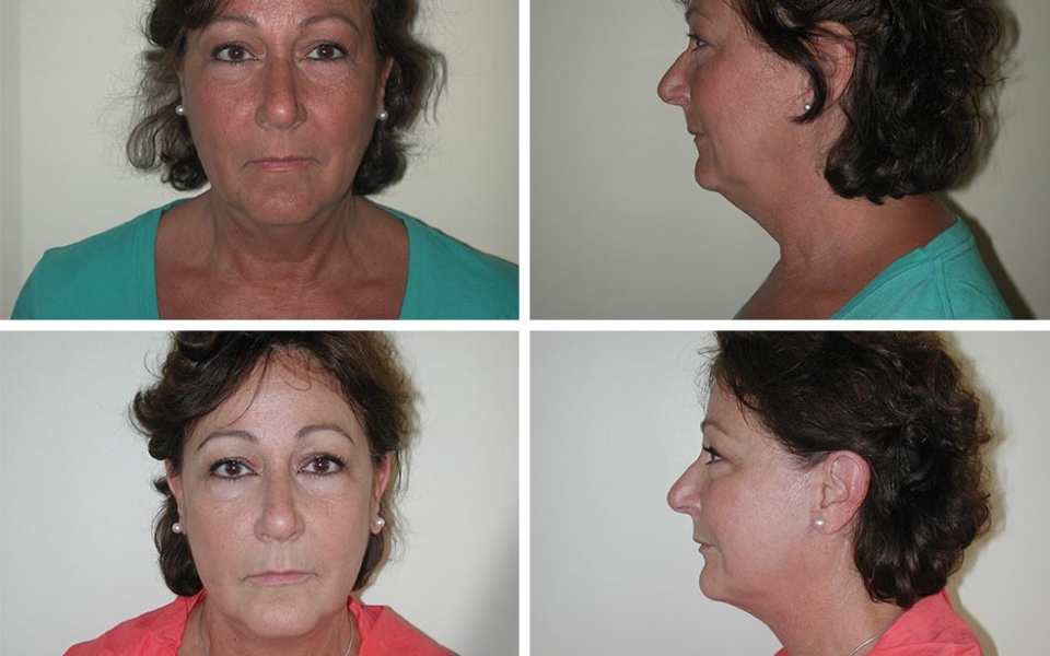 Facelift | Plastic Surgery of Tulsa