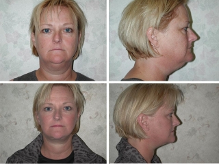 Facelift | Plastic Surgery of Tulsa