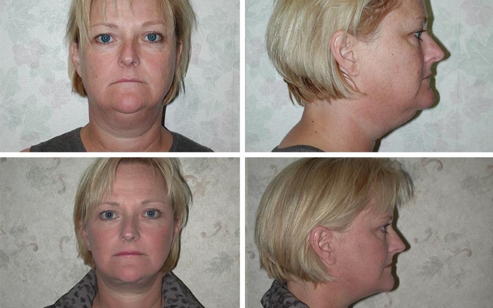 Facelift | Plastic Surgery of Tulsa