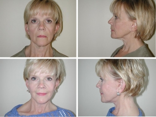 Facelift | Plastic Surgery of Tulsa