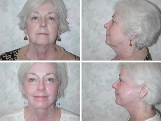 Facelift | Plastic Surgery of Tulsa
