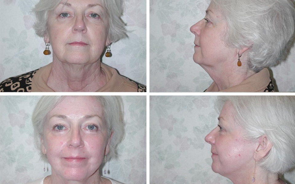 Facelift | Plastic Surgery of Tulsa