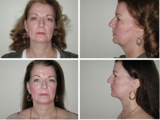 Facelift | Plastic Surgery of Tulsa