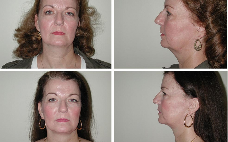 Facelift | Plastic Surgery of Tulsa