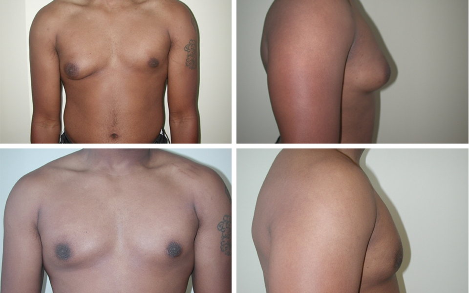 Gynecomastia | Plastic Surgery of Tulsa