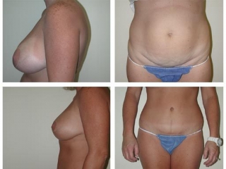 Abdomnioplasty | Mommy Makeover at Plastic Surgery of Tulsa
