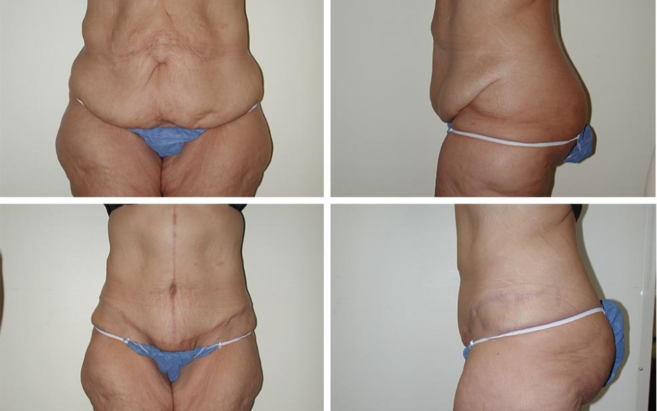 Abdominiplasty | Tummy Tuck | Plastic Surgery of Tulsa