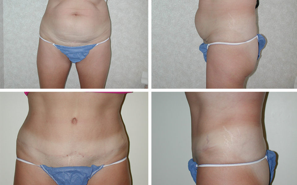 Abdominoplasty | Plastic Surgery of Tulsa