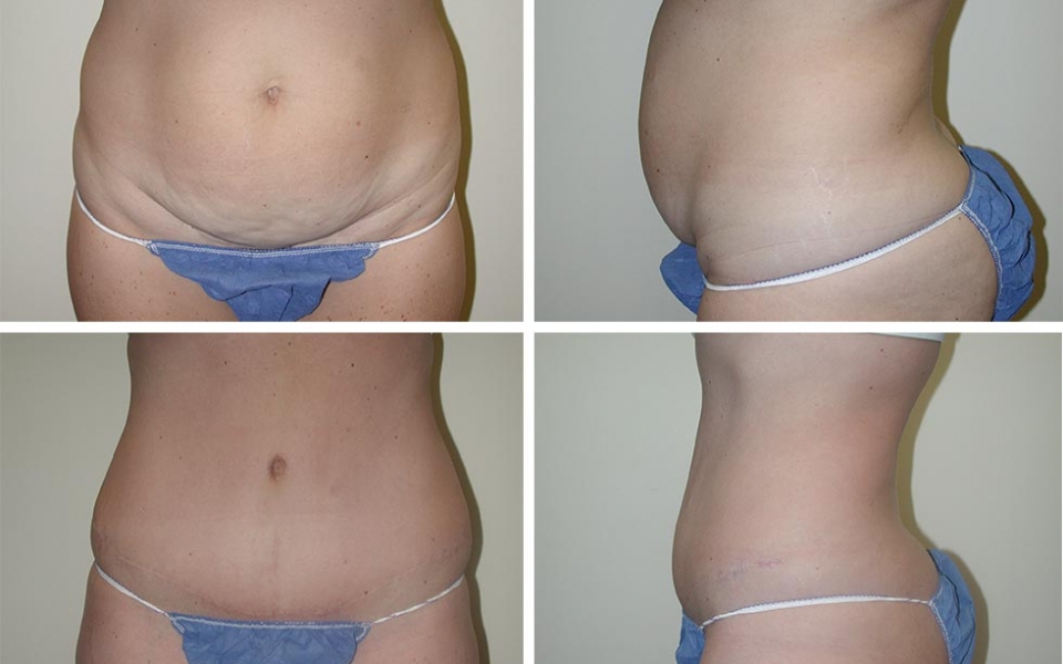 Abdominoplasty | Plastic Surgery of Tulsa