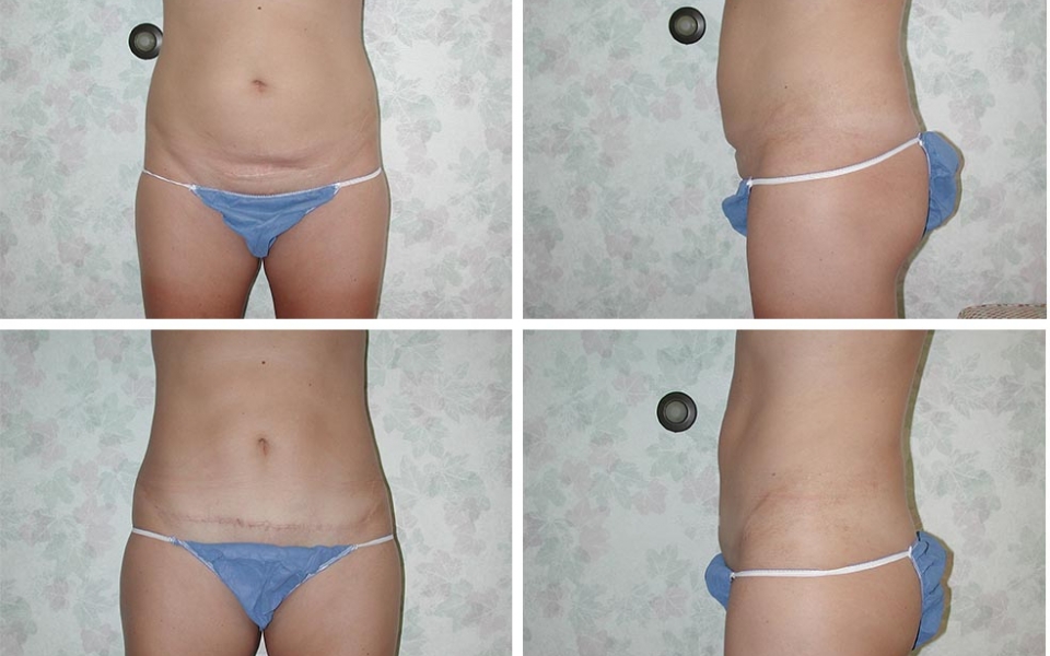 Abdominoplasty | Plastic Surgery of Tulsa