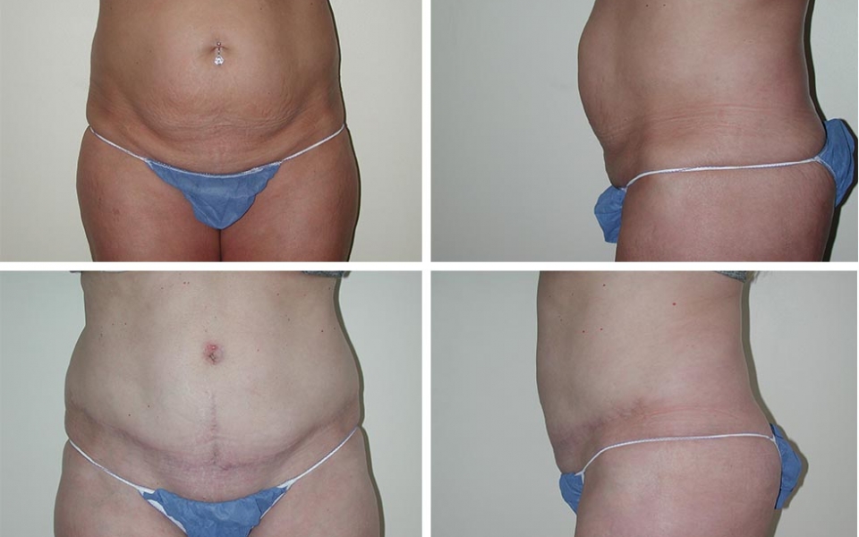 Abdominoplasty | Plastic Surgery of Tulsa