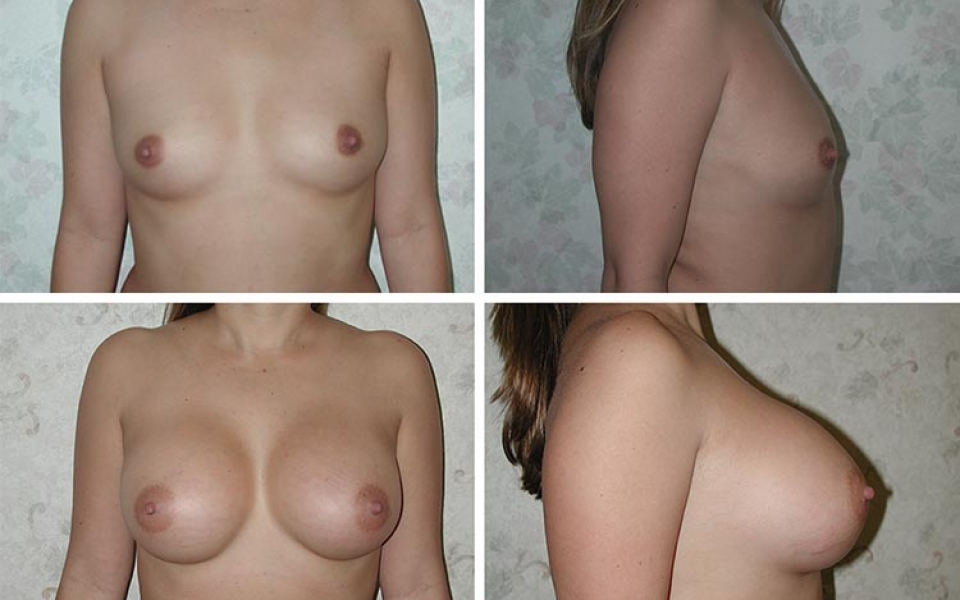 Breast Augmentation | Plastic Surgery of Tulsa