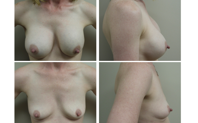 breast implant removal