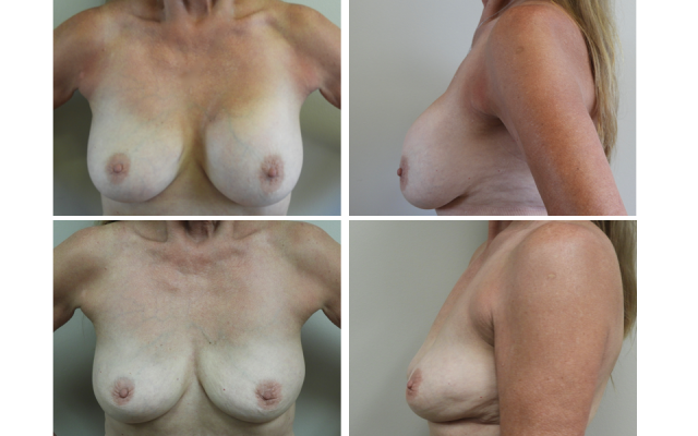 breast implant removal