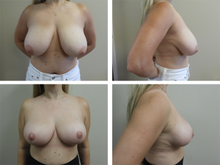 Tulsa Breast Lift Mastopexy