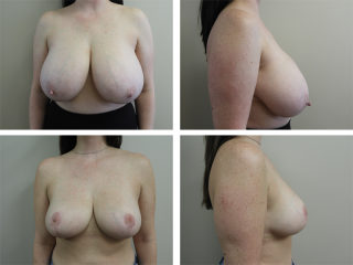 Tulsa Breast Reduction