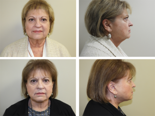 Tulsa Facelift Bleph