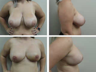 Tulsa Breast Reduction