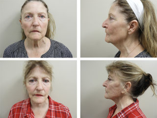 Tulsa Facelift Bleph