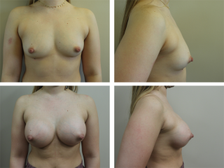 Tulsa Breast Augmentation