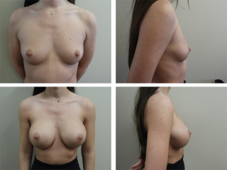 Tulsa Breast Augmentation